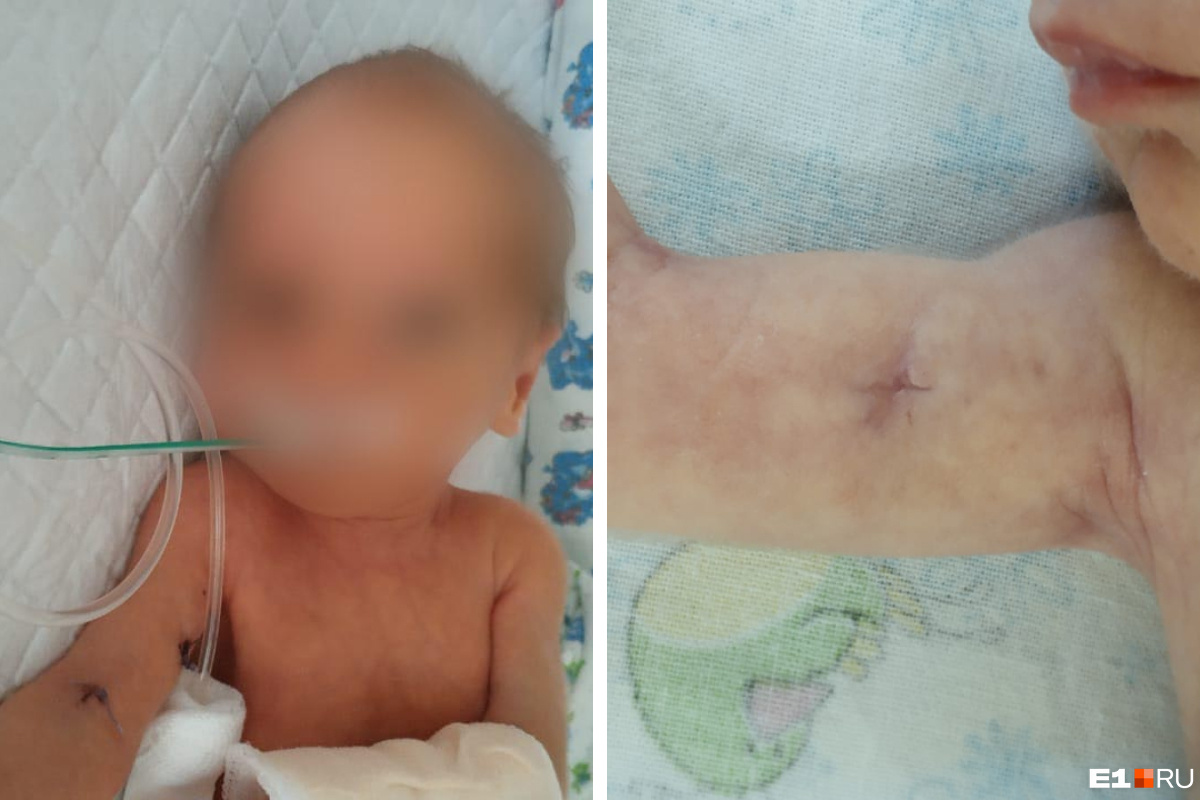 Мальчик родился весом 1320 граммов и за первые два дня жизни перенес две операции